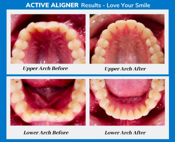 Active Aligners: Before and After
